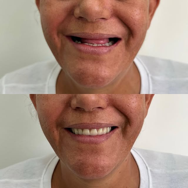 Transformación de sonrisa — antes y después
